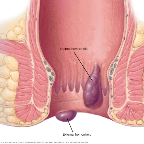 Piles Treatment - Anti Piles Complete Resolution